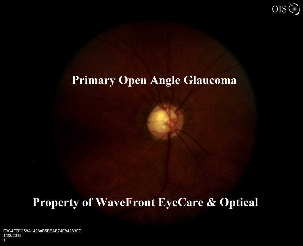 glaucoma